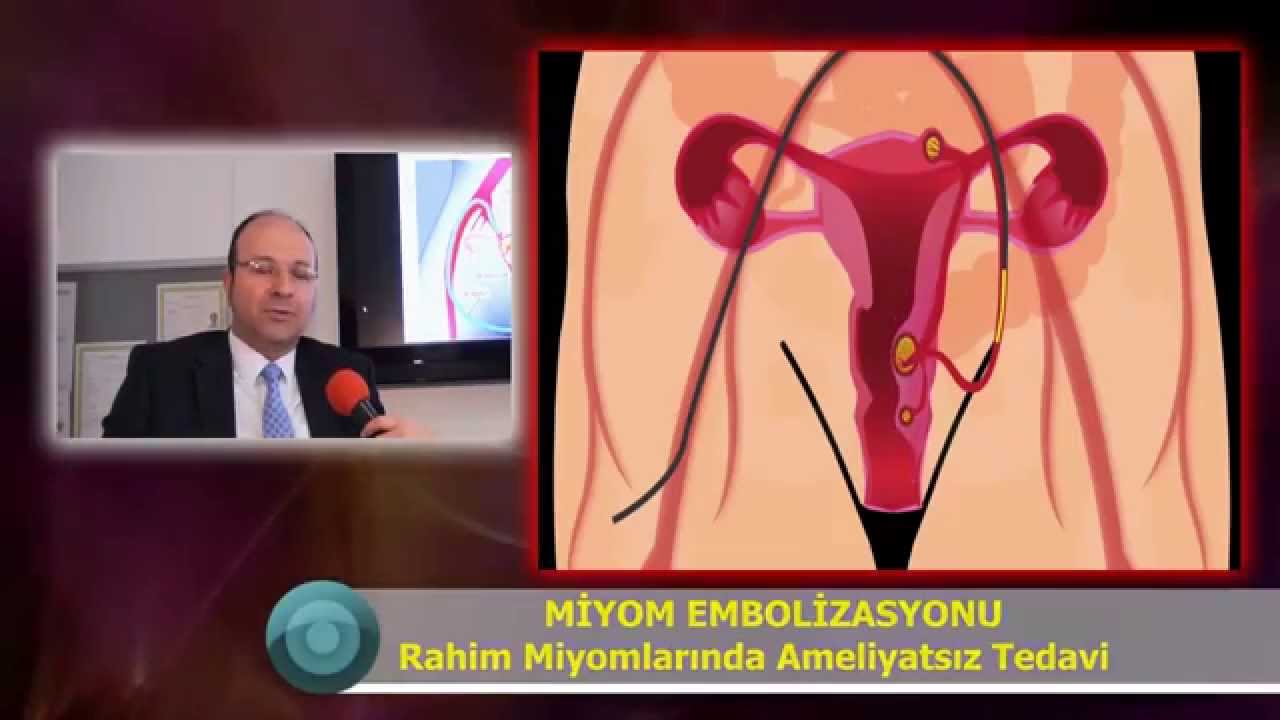 Miyomlarda Ameliyatsız Tedavi Sonuçları Miyomun ameliyatsız tedavisi miyom ameliyatı