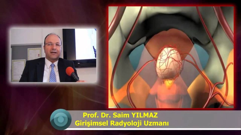 Miyomların Teşhisi ve Tedavi Yöntemleri Miyom Ameliyatsız Tedavi Rahim miyomu tedavisi