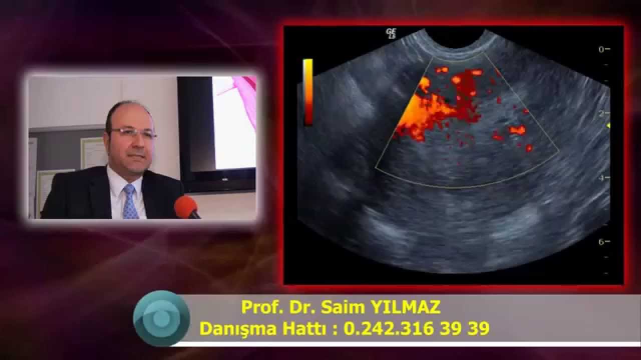 Miyom Embolizasyonu Adenomiyozis Rahimde Miyom Ameliyatsız Tedavisi