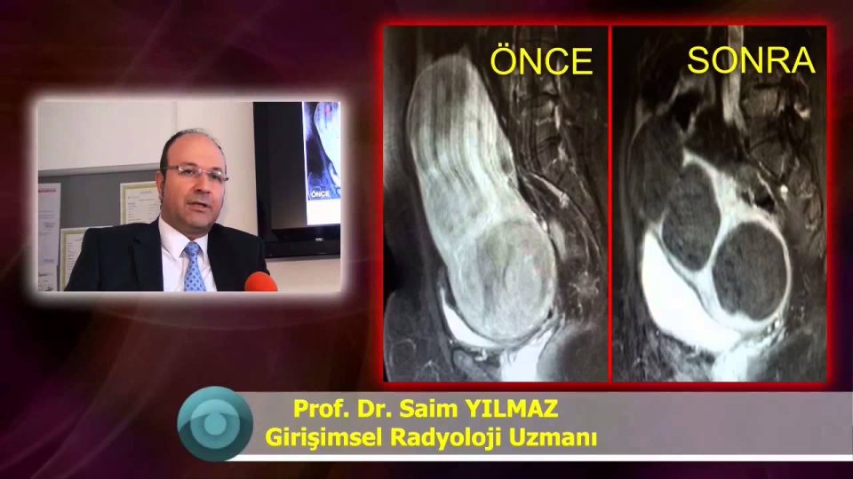 Ameliyatsız Miyom Tedavisi Miyom Embolizasyonu Adenomiyozis Tedavisi Uzmanı Nedir Nasıl